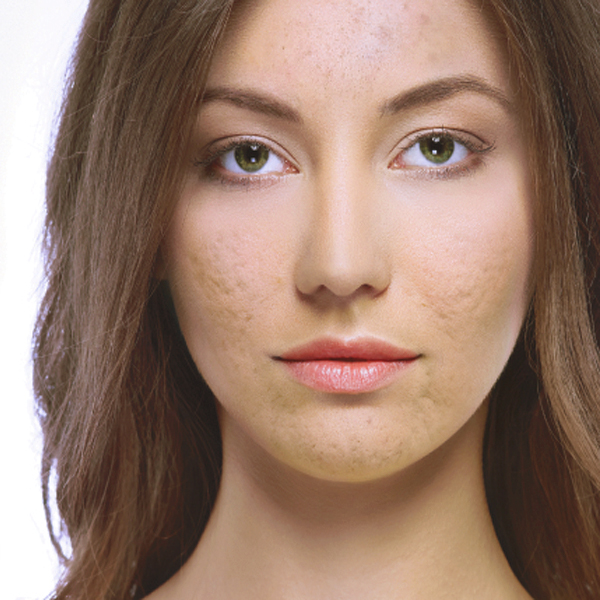 Enerjet – acne 3