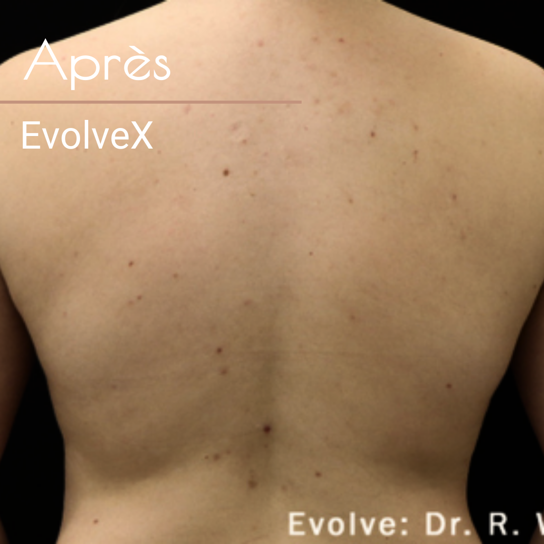 Evovlex apres