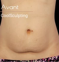 Coolsculpting-apres