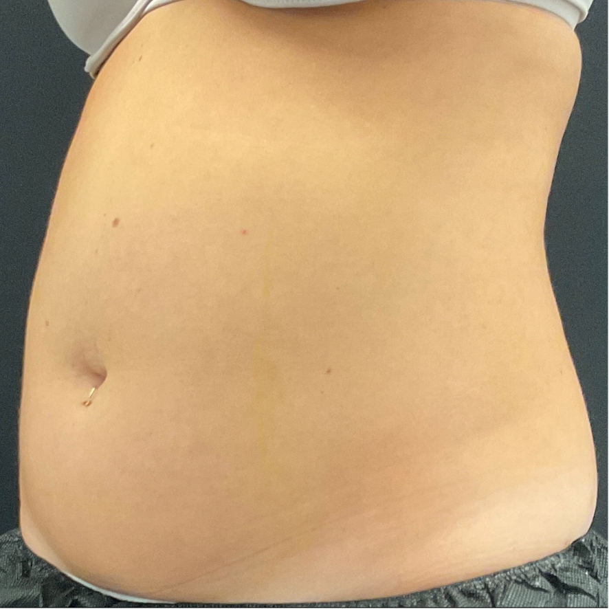Avant CoolSculpting (1) 1 séance