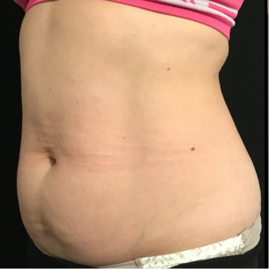 Avant CoolSculpting (2) 1 séance