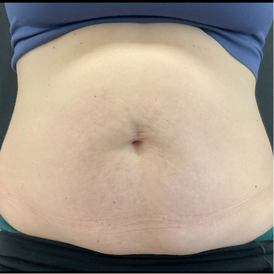 Avant CoolSculpting (5) 1 séance
